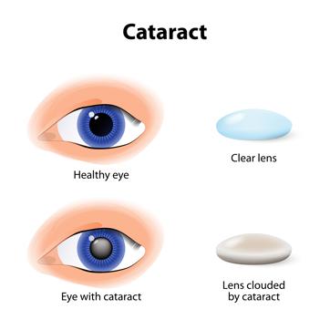 Cataract is a common condition in which the lens of the eye becomes cloudy as a result of oxidation over time. (Shutterstock) Cataract is a common condition in which the lens of the eye becomes cloudy as a result of oxidation over time. (Shutterstock)