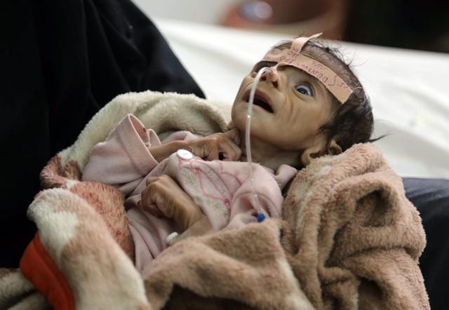 Infant Udai Faisal, who is suffering from acute malnutrition, is hospitalized at Al-Sabeen Hospital in Sanaa, Yemen. Udai died on March 24. Hunger has been the most horrific consequence of Yemen’s conflict and has spiraled since Saudi Arabia and its allies, backed by the U S launched a campaign of airstrikes and a naval blockade a year ago. (AP) Infant Udai Faisal, who is suffering from acute malnutrition, is hospitalized at Al-Sabeen Hospital in Sanaa, Yemen. Udai died on March 24. Hunger has been the most horrific consequence of Yemen’s conflict and has spiraled since Saudi Arabia and its allies, backed by the U S launched a campaign of airstrikes and a naval blockade a year ago. (AP)