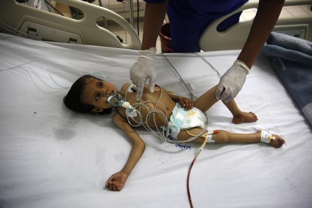 A nurse takes care of a malnourished boy at Al-Sabeen hospital in Sanaa, Yemen. (AP) A nurse takes care of a malnourished boy at Al-Sabeen hospital in Sanaa, Yemen. (AP)