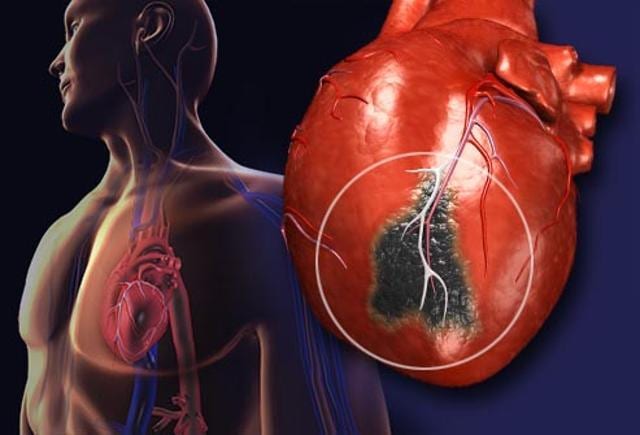 An experimental drug that greatly increases levels of “good” cholesterol has no effect on heart health, a comprehensive clinical trial found, leaving researchers shocked and disappointed. (webmd.com) An experimental drug that greatly increases levels of “good” cholesterol has no effect on heart health, a comprehensive clinical trial found, leaving researchers shocked and disappointed. (webmd.com)
