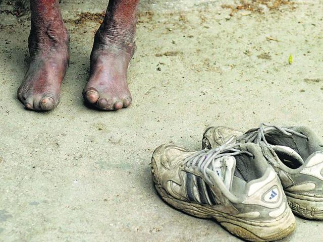 Seven states of the country were evaluated based on the implementation of National Leprosy Eradication Program from 2012 to 2017. (HT Photo) Seven states of the country were evaluated based on the implementation of National Leprosy Eradication Program from 2012 to 2017. (HT Photo)