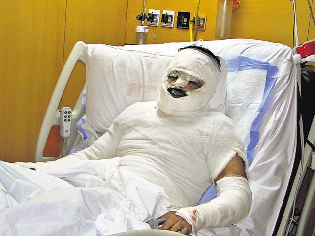 The victim sustains 40% burns on his face, chest, abdomen and arms.(Sakib Ali/HT Photo)