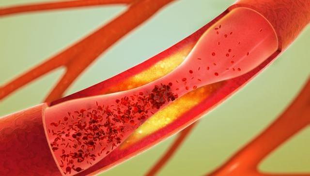 Fragmentation of elastic fibres within the arterial wall is the new culprit. (Shutterstock) Fragmentation of elastic fibres within the arterial wall is the new culprit. (Shutterstock)