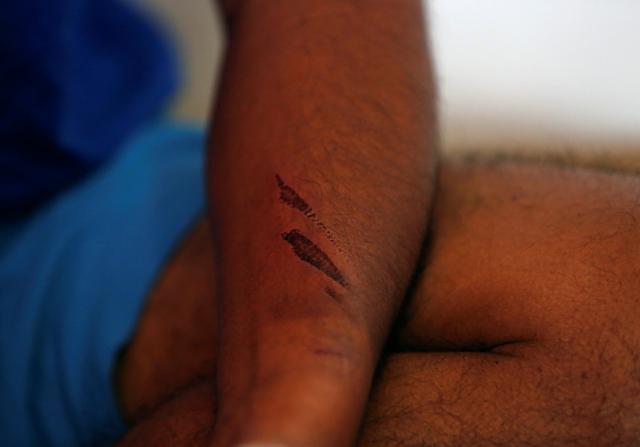 A bruise on the hand of Indian climber Nava Kumar Phukon. (REUTERS)