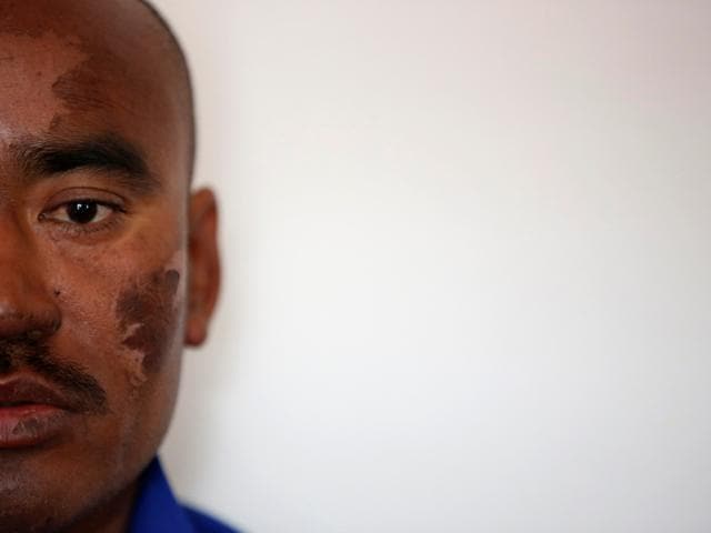 Indian climber Nava Kumar Phukon, who says he successfully climbed Mount Everest, speaks with the media with a bruise on his face, at a hotel in Kathmandu Nepal, May 24, 2016. (REUTERS)