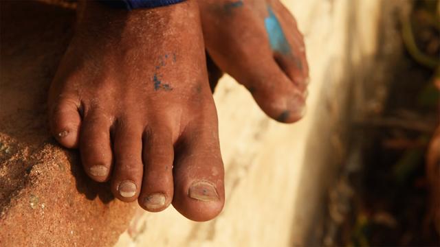 <p>India has the highest number of slaves than any other country in the world. In fact the number of slaves in India is more than the combined number of slaves in over a dozen countries. India has been ranked 4th among 167 countries when it comes to countries with the highest proportion of their population in modern slavery.The survey data suggests that there are more than 18 million people living in conditions of modern slavery in India. Industries implicated include domestic work, the construction and sex industries, agriculture, fishing, manufacturing, manual labour, and forced begging. We profile two such boys who were rescued by Bachpan Bachao Andolan.</p>