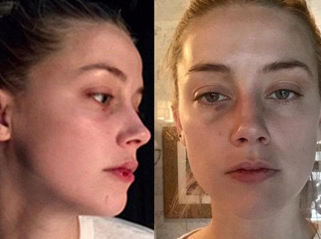 Johnny Depp divorce: New images of a beaten, bruised Amber Heard emerge -  Hindustan Times
