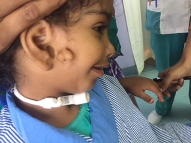 Albaraa Rashid from Oman was brought to India with a rare deformity – she was born with the right side of her jaw missing. Doctors say one in 10 lakh people are born with the defect. She also had an extra ear, making her condition even more complex. (HT Photo) Albaraa Rashid from Oman was brought to India with a rare deformity – she was born with the right side of her jaw missing. Doctors say one in 10 lakh people are born with the defect. She also had an extra ear, making her condition even more complex. (HT Photo)