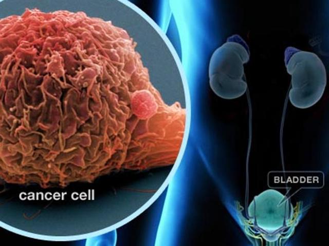 As part of the latest study findings to be presented at the Chicago meeting, injections of the experimental agent atezolizumab were found to shrink tumors by at least 30 percent and stall new tumor growth in 28 of 119 (or 24 percent of) patients. (webmd.com) As part of the latest study findings to be presented at the Chicago meeting, injections of the experimental agent atezolizumab were found to shrink tumors by at least 30 percent and stall new tumor growth in 28 of 119 (or 24 percent of) patients. (webmd.com)