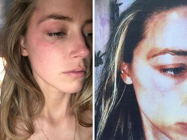 Amber Heard submitted pictures to the court showing a bruise on her face that she claims was inflicted during a fight with Johnny Depp on Saturday and said she feared Depp might harm her. (Reuters) Amber Heard submitted pictures to the court showing a bruise on her face that she claims was inflicted during a fight with Johnny Depp on Saturday and said she feared Depp might harm her. (Reuters)