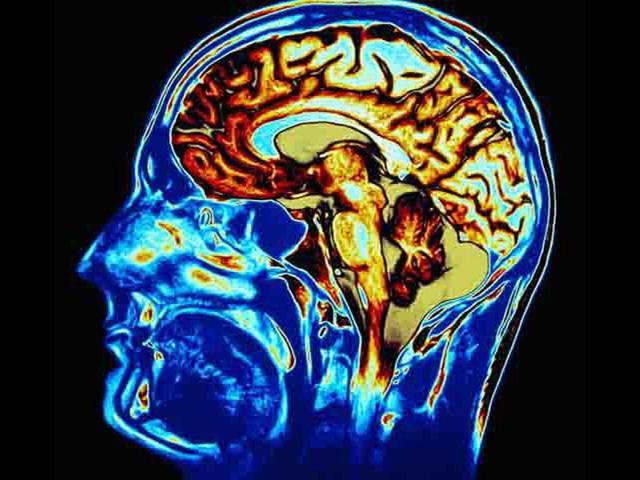 Increased levels of a gene involved in the production of toxic proteins in the brain that lead to Alzheimer’s-like symptoms could also lead to the development of diabetes symptoms.(Shutterstock)