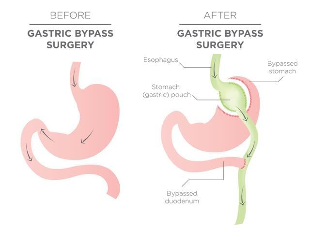 Bariatric surgery is a procedure that bypasses the gastrointestinal tract and leaves only a pouch of the stomach, resulting in a substantial cut in food intake and weight loss. (Shutterstock) Bariatric surgery is a procedure that bypasses the gastrointestinal tract and leaves only a pouch of the stomach, resulting in a substantial cut in food intake and weight loss. (Shutterstock)