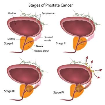 Prostate cancer is often a rather indolent disease with favourable prognosis that often doesn’t require treatment. (Shutterstock) Prostate cancer is often a rather indolent disease with favourable prognosis that often doesn’t require treatment. (Shutterstock)