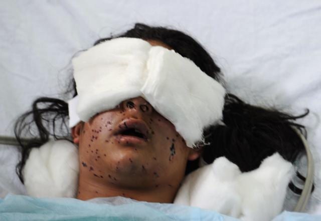Indian Kashmiri girl Insha Malik, 14, lays unconscious in a hospital bed after being shot with pellets fired by Indian security forces, with doctors saying she had lost vision in both eyes, in the surgical ICU hospital in Srinagar on July 14.(AFP) Indian Kashmiri girl Insha Malik, 14, lays unconscious in a hospital bed after being shot with pellets fired by Indian security forces, with doctors saying she had lost vision in both eyes, in the surgical ICU hospital in Srinagar on July 14.(AFP)