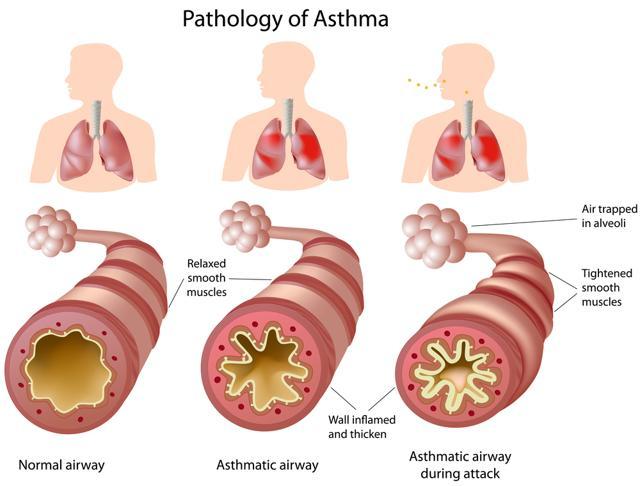 Asthma is a chronic disease that can be made worse by outdoor air pollution, stress and sleep disruption. (Shutterstock) Asthma is a chronic disease that can be made worse by outdoor air pollution, stress and sleep disruption. (Shutterstock)