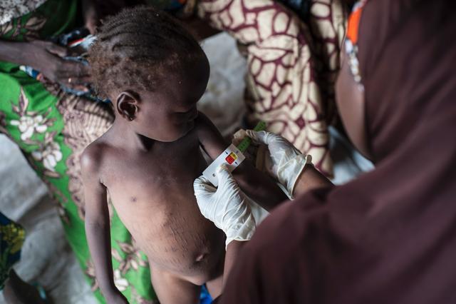 A woman measures the diameter of a girl's arm suffering from severe acute malnutrition in the Muna informal settlement in the outskirts of Maiduguri capital of Borno State, northeastern Nigeria. (AFP file photo) A woman measures the diameter of a girl's arm suffering from severe acute malnutrition in the Muna informal settlement in the outskirts of Maiduguri capital of Borno State, northeastern Nigeria. (AFP file photo)