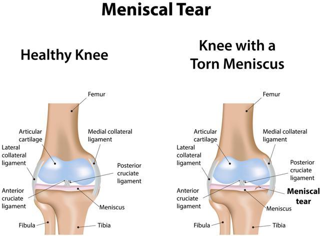 Meniscal tear is the damage to the rubbery discs that cushion the knee joint. (Shutterstock) Meniscal tear is the damage to the rubbery discs that cushion the knee joint. (Shutterstock)