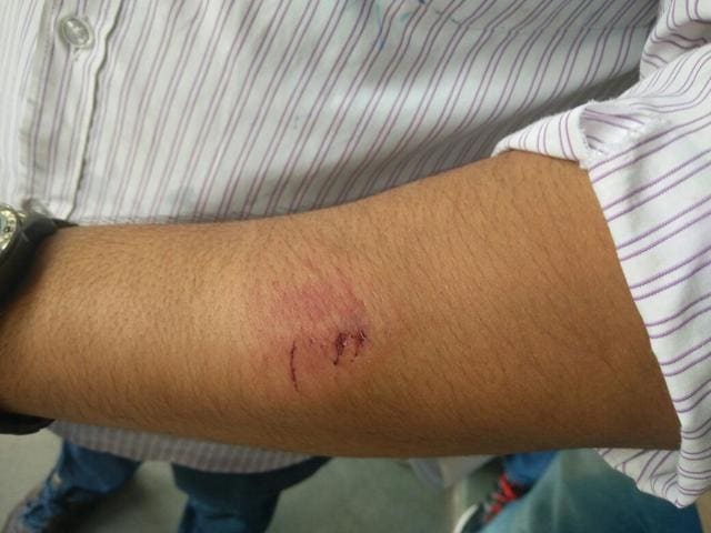 Doctor gets bitten by the relative of a patient, who died in the hospital on Wednesday night. (HT Photo) Doctor gets bitten by the relative of a patient, who died in the hospital on Wednesday night. (HT Photo)