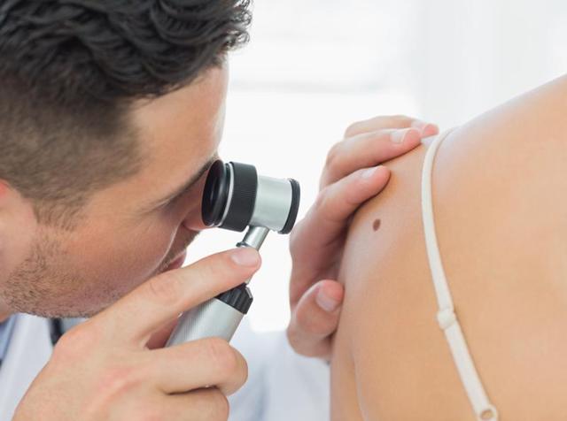 Melanoma is a skin cancer which develops from the pigment-containing cells. (Shutterstock) Melanoma is a skin cancer which develops from the pigment-containing cells. (Shutterstock)