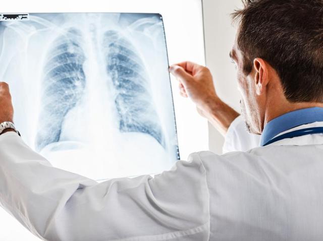 Advances in lung cancer therapy require a greater understanding of the molecular origins of the disease, say researchers. (Shutterstock) Advances in lung cancer therapy require a greater understanding of the molecular origins of the disease, say researchers. (Shutterstock)