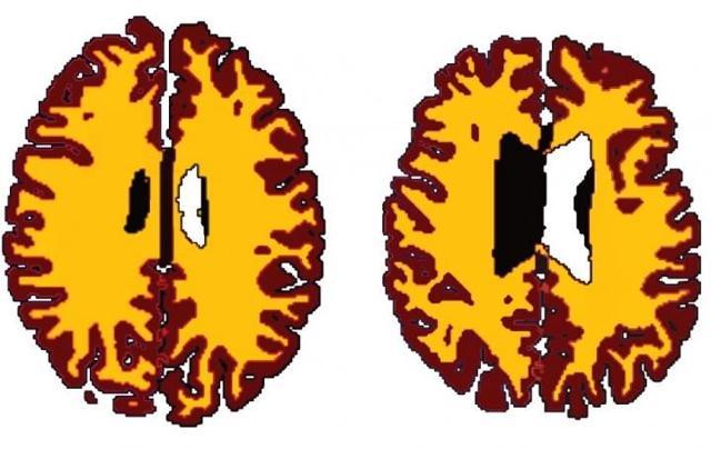 MRI scans from a study by the University of Cambridge, UK, show the comparison of grey matter (brown) and white matter (yellow) in a lean subjects (left) and an obese subject (right). (AFP) MRI scans from a study by the University of Cambridge, UK, show the comparison of grey matter (brown) and white matter (yellow) in a lean subjects (left) and an obese subject (right). (AFP)