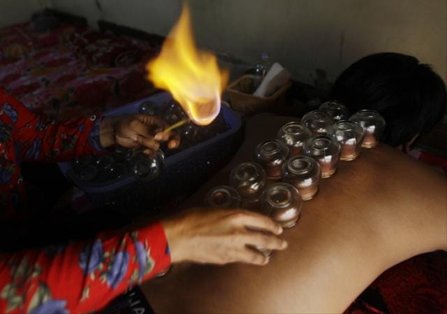 Cupping therapy being practised. (AP) Cupping therapy being practised. (AP)