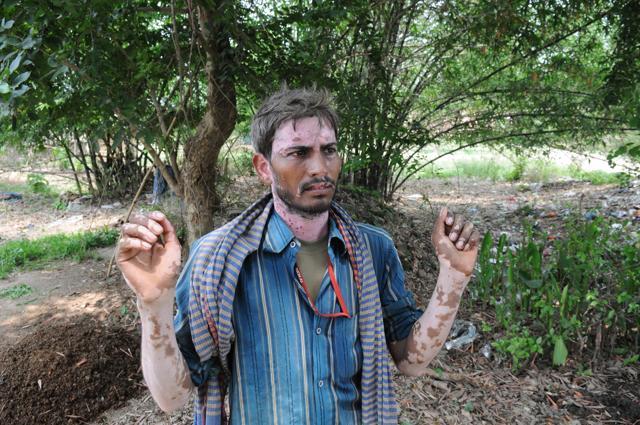 A villager shows his hand and face infected by drinking arsenic infected water at Simri in Buxar district. Pic A P Dube (AP Dube/HT Photo) A villager shows his hand and face infected by drinking arsenic infected water at Simri in Buxar district. Pic A P Dube (AP Dube/HT Photo)