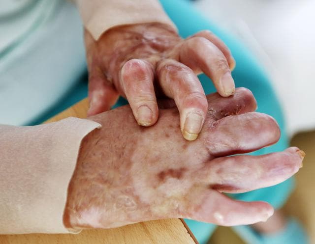 In this July 28, 2016 picture, 17-year-old Yazidi girl Yasmin shows her hands at her home in Germany. After escaping the clutches of Islamic State, Yasmin, a Yazidi girl, was so traumatized by her captivity that she poured gasoline on herself and set it alight - hoping to render herself no longer desirable to the extremists. (AP) In this July 28, 2016 picture, 17-year-old Yazidi girl Yasmin shows her hands at her home in Germany. After escaping the clutches of Islamic State, Yasmin, a Yazidi girl, was so traumatized by her captivity that she poured gasoline on herself and set it alight - hoping to render herself no longer desirable to the extremists. (AP)