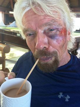 Handout image issued by Virgin.com of Sir Richard Branson after he was involved in an accident. (AP Photo)