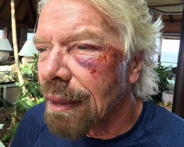 The Virgin founder badly damaged his cheek and suffered severe cuts to his knee, chin and shoulder (AP Photo)