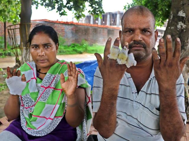 Raju Yadav and his wife Sunita Devi showing their injuries. (HT Photo) Raju Yadav and his wife Sunita Devi showing their injuries. (HT Photo)