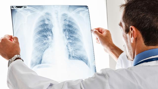 Increased physical activity among patients with a type of lung disease could reduce their risk of anxiety as well as depression, a study has found. (Shutterstock)
