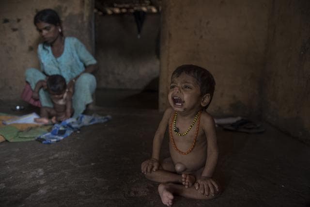 Three-year-old Manoj Pawar who is suffering from malnutrition at Palghar in Maharashtra.(Satish Bate/HT Photo)