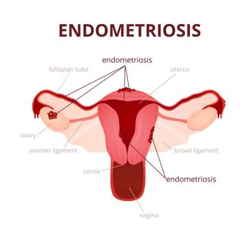 Surgery can be used to remove wounds and relieve pain of endometriosis, but between 5% to 20%, there is a high risk of repetition for severe cases. (Shutterstock)
