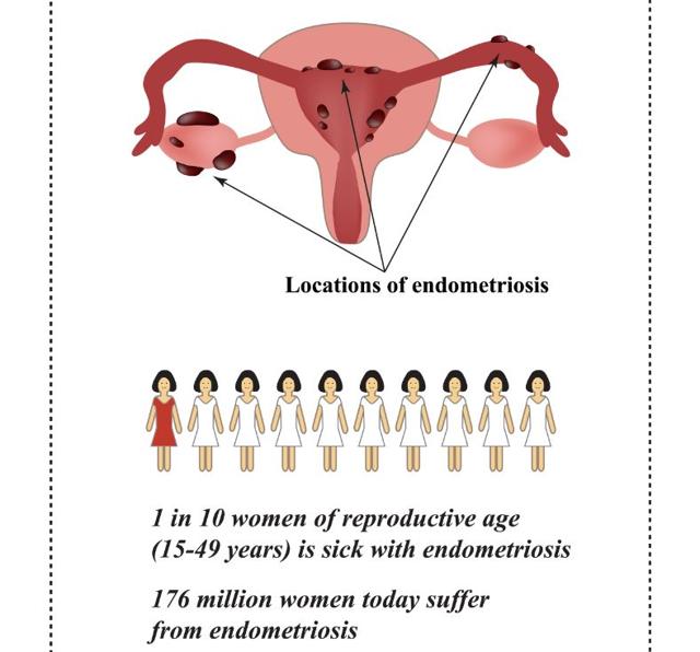 All that you need to know about endometriosis, a disease of the uterus ...