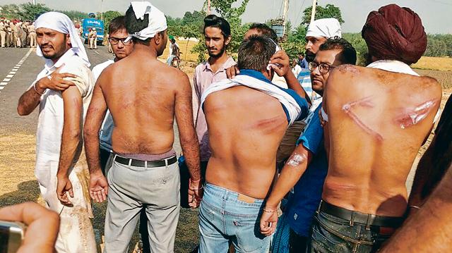 Protester showing their injury marks. (SANJEEV KUMAR/HT) Protester showing their injury marks. (SANJEEV KUMAR/HT)