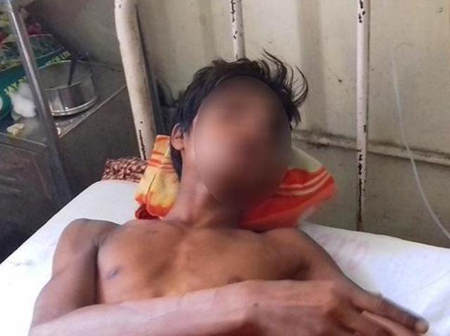 One of the two minor boys was subjected to diversion colostomy at GTB hospital in Delhi after torture. (Sakib Ali/HT Photo) One of the two minor boys was subjected to diversion colostomy at GTB hospital in Delhi after torture. (Sakib Ali/HT Photo)