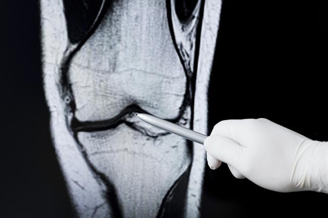 The scientists discovered that a hormone called PTH stopped the action of certain enzymes (SIK2) that block bone formation. (iStock)
