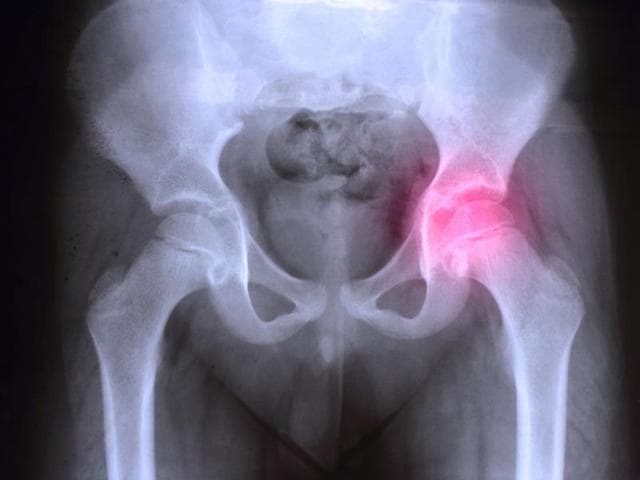 The research from the University of East Anglia (UEA) shows that, surprisingly, patients’ physical activity does not increase following hip replacement surgery. (Shutterstock) The research from the University of East Anglia (UEA) shows that, surprisingly, patients’ physical activity does not increase following hip replacement surgery. (Shutterstock)