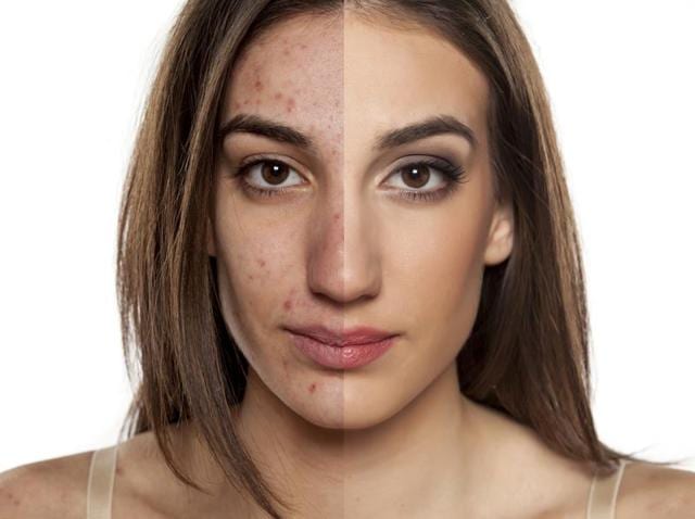 The study showed that when trapped in airless environments alongside hair and skin cells, propionibacterium acnes turns serum -- the oil found on our skin -- into fatty acids that activate inflammation in nearby skin cells.(Shutterstock)