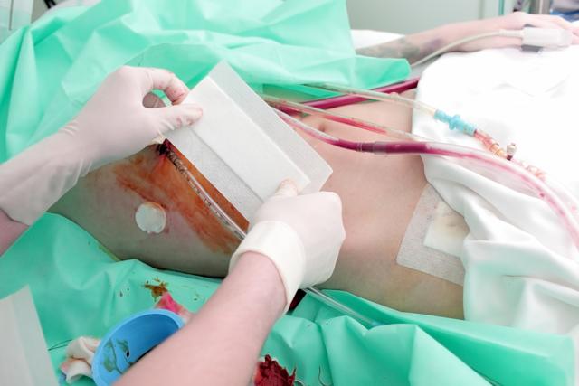 Transplantation is needed when diseases such as diabetes, chronic nephritis, uncontrolled hypertension, polycystic ovaries etc lead to irreversible kidney damage and lower kidney function to less than 10%. (Shutterstock) Transplantation is needed when diseases such as diabetes, chronic nephritis, uncontrolled hypertension, polycystic ovaries etc lead to irreversible kidney damage and lower kidney function to less than 10%. (Shutterstock)