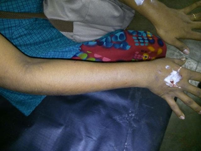 The complainant shows her bite wounds after receiving medical aid. (Surendra Negi) The complainant shows her bite wounds after receiving medical aid. (Surendra Negi)