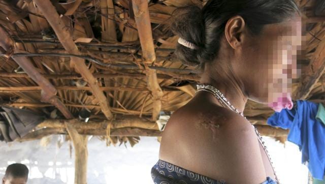 This Peddagellur survivor and her daughter-in-law were assaulted and gangraped. She was assaulted with rifles on her right shoulder, and sustains this injury. (Chitrangada Choudhury/HT File Photo) This Peddagellur survivor and her daughter-in-law were assaulted and gangraped. She was assaulted with rifles on her right shoulder, and sustains this injury. (Chitrangada Choudhury/HT File Photo)