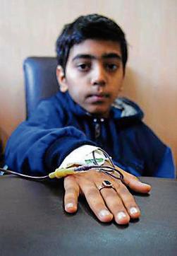 A boy suffering from the disorder. (Anil Dayal/HT ) A boy suffering from the disorder. (Anil Dayal/HT )