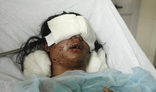 Insha Mushtaq was blinded when she opened a window in her home in south Kashmir and a pellet cartridge hit her. She has become the global face of Kashmir’s pellet woes: hundreds of people who were blinded or maimed by pellet guns used by security forces to manage crowds. (Waseem Andrabi/ HT Photo) Insha Mushtaq was blinded when she opened a window in her home in south Kashmir and a pellet cartridge hit her. She has become the global face of Kashmir’s pellet woes: hundreds of people who were blinded or maimed by pellet guns used by security forces to manage crowds. (Waseem Andrabi/ HT Photo)