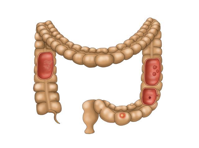 Colorectal cancer linked to a strain of gut bacteria called Fusobacterium nucleatum. (Shutterstock)