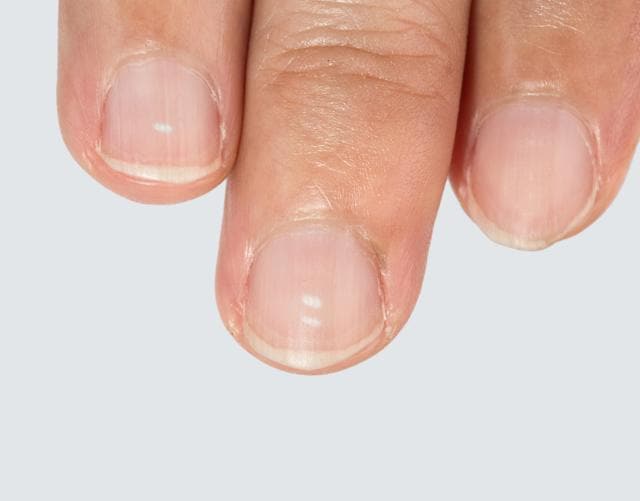 White spots on my baby's nail | BabyCenter
