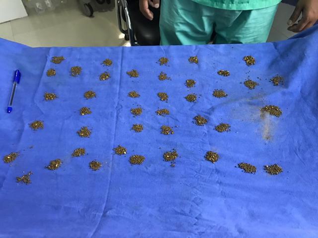 Dr Jindal, who conducted the surgery on Shabbir, said the weight of the gallstones doesn’t matter as the they are made of cholesterol and can float on water. (HT photo) Dr Jindal, who conducted the surgery on Shabbir, said the weight of the gallstones doesn’t matter as the they are made of cholesterol and can float on water. (HT photo)