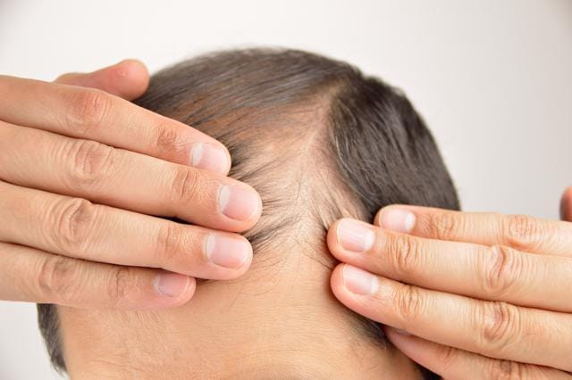 8 Myths and Truths about Hair Loss  ISDIN