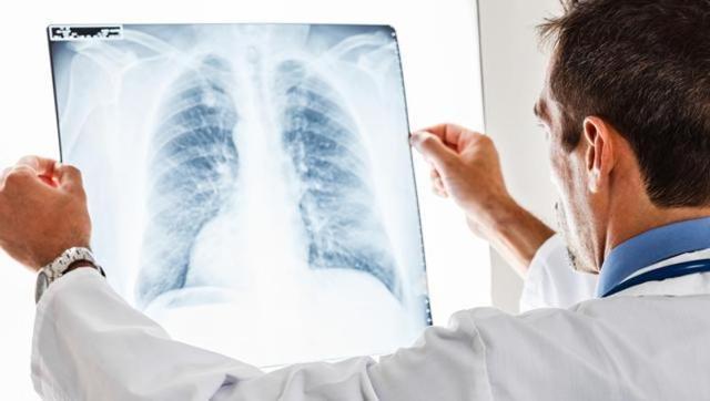 Chronic lung disease puts one at risk of TB infection. (Shutterstock) Chronic lung disease puts one at risk of TB infection. (Shutterstock)